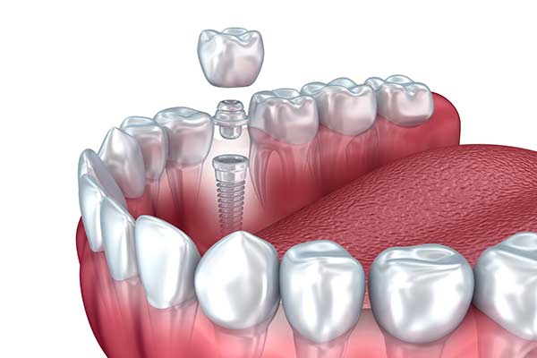 Why Dental Implants Are Better Than Other Tooth Repair » St. Louis