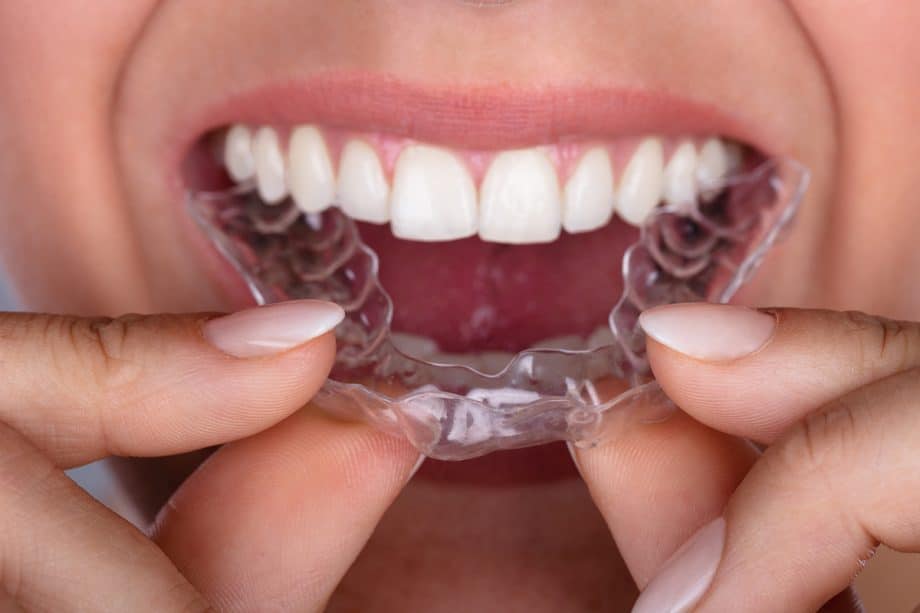 How Long Does Invisalign Take to Straighten Teeth?